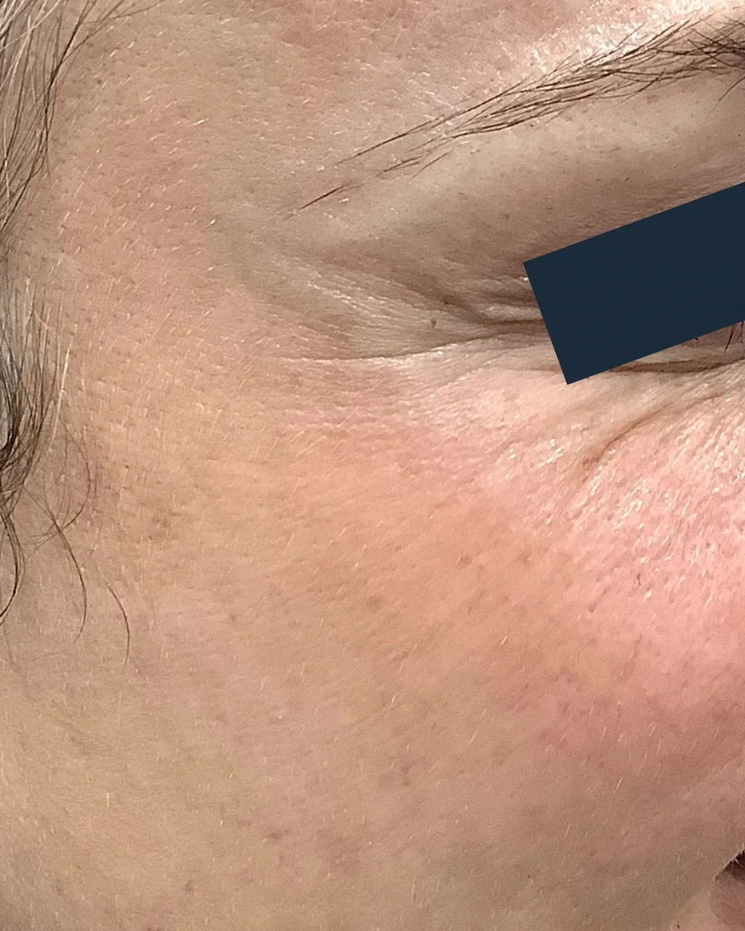 After neuromodulator treatment for crow's feet